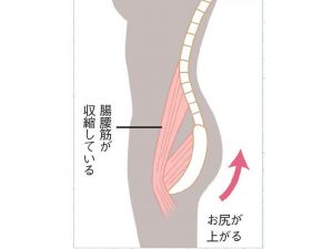 腸腰筋が収縮した図